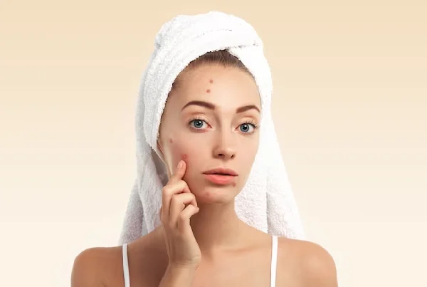 Acne, Scars and Stretch Mark Treatments